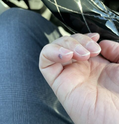 痛いわぁ～( ﾉД`)ｼｸｼｸ…